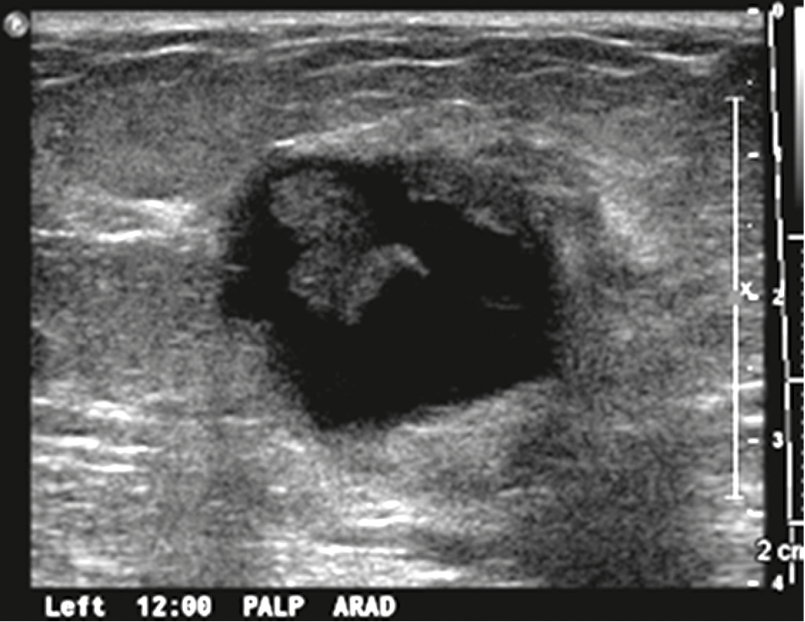 Radiologic and Pathologic Findings from Breast Biopsy